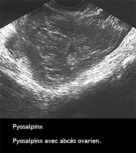 Pyosalpinx 5