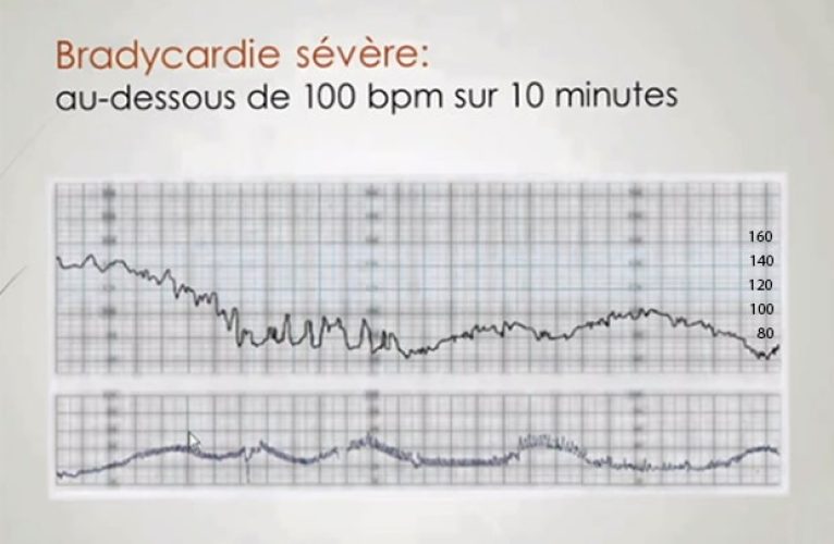RCF bradycardie sévère — tracé cardiotocographique urgence obstétricale