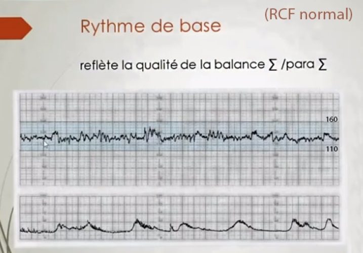 RCF normal — tracé cardiotocographique de référence