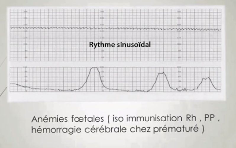 RCF rythme sinusoïdal — tracé pathologique signe de souffrance fœtale