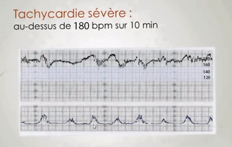RCF tachycardie sévère — tracé cardiotocographique pathologique