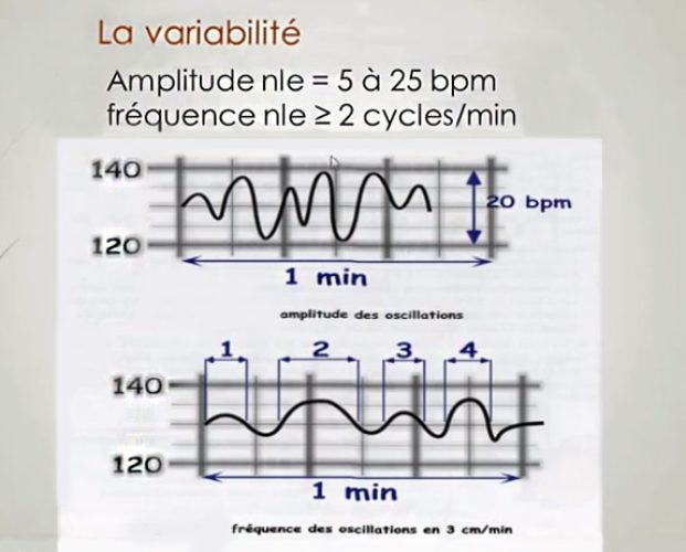 RCF variabilité 2 — oscillations du rythme cardiaque fœtal