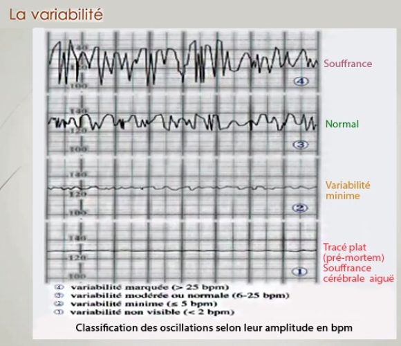 RCF variabilité 3 — tracé cardiotocographique interprétation