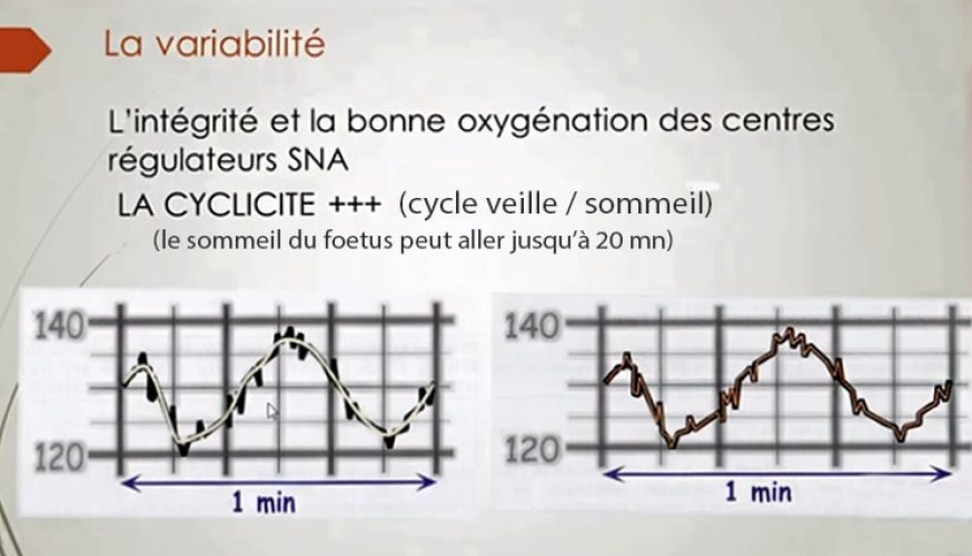 RCF variabilité — analyse du rythme cardiaque fœtal normal