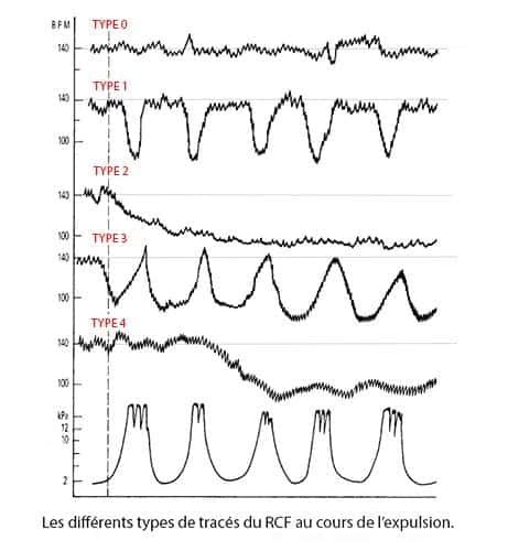 RCF expulsion — tracé cardiotocographique phase expulsive accouchement