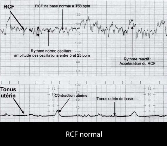 RCF normal 2 — tracé cardiotocographique réactif normal de référence