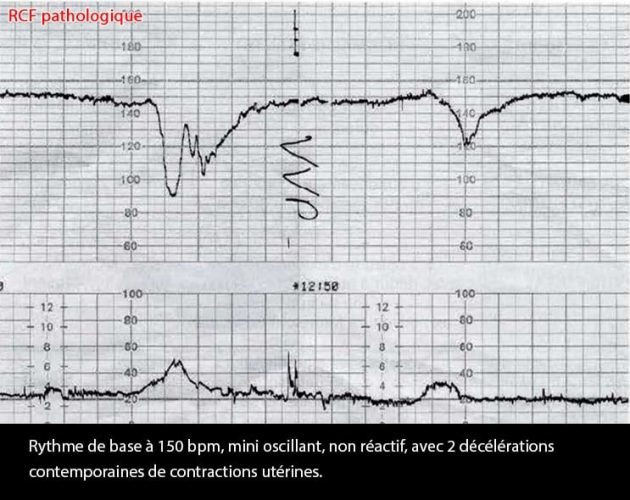 RCF pathologique 2 — tracé cardiotocographique anormal souffrance fœtale
