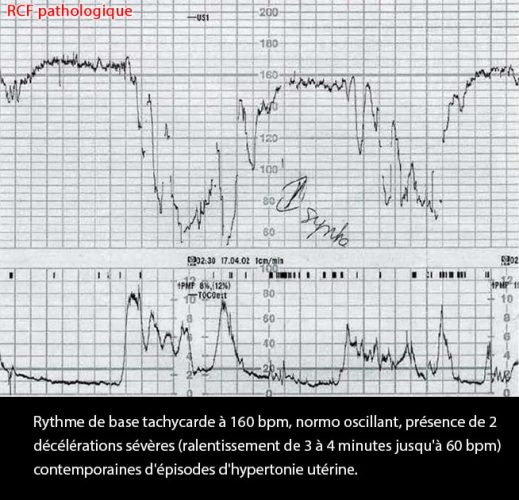 RCF pathologique 3 — tracé cardiotocographique anormal souffrance fœtale