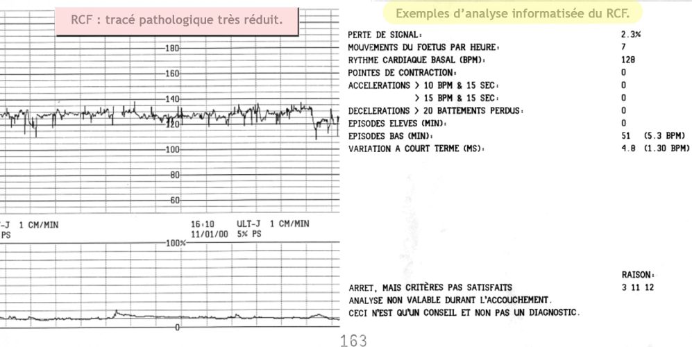 RCF_pathologique