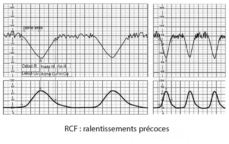 RCF ralentissements précoces — décélérations précoces cardiotocographie