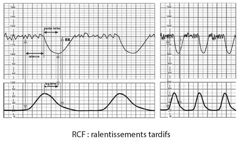 RCF ralentissements tardifs — décélérations tardives souffrance fœtale