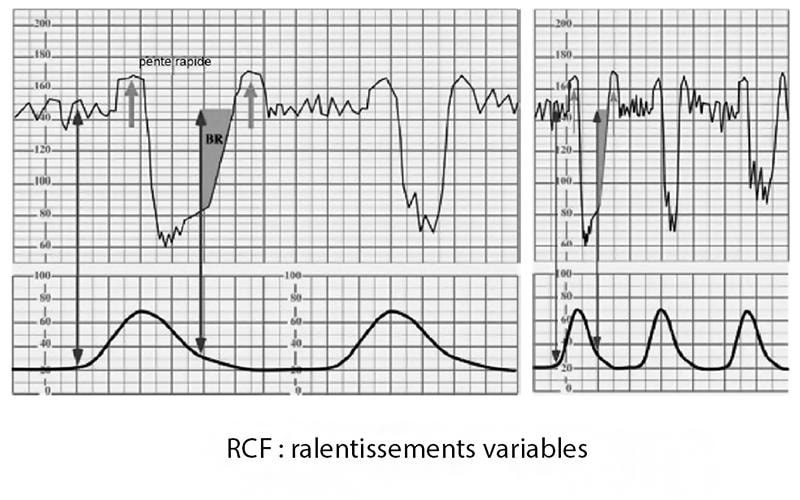 RCF ralentissements variables — décélérations variables cardiotocographie