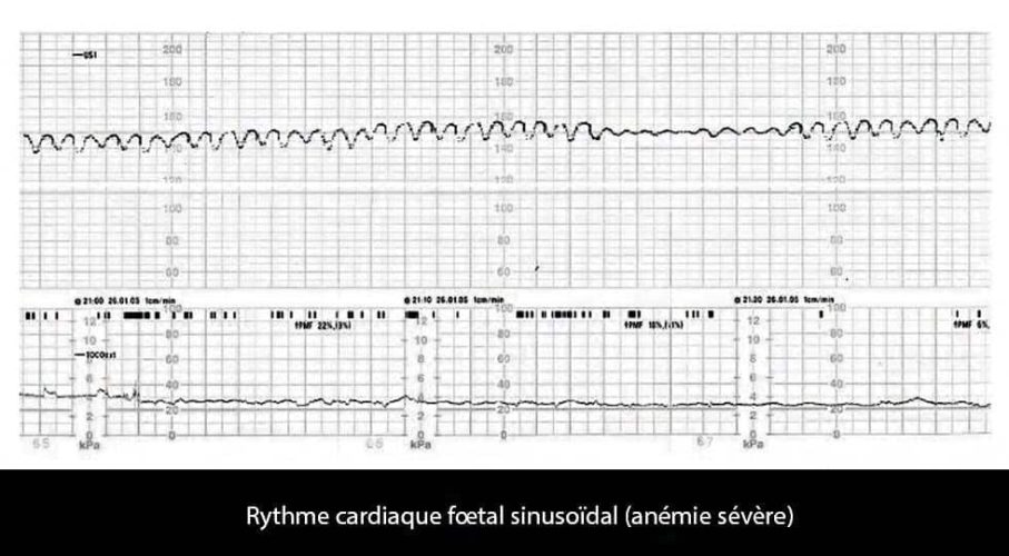 RCF sinusoïdal — tracé cardiotocographique pathologique souffrance fœtale