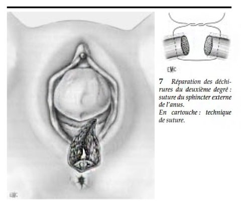 Reparation dechirure 1