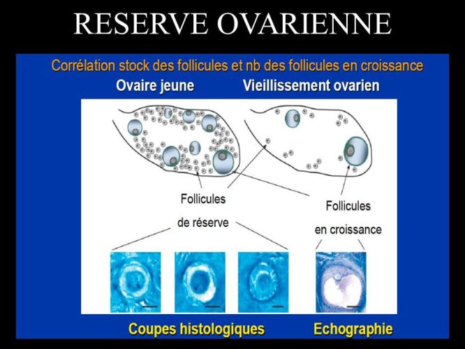 Réserve ovarienne — évaluation échographique des follicules