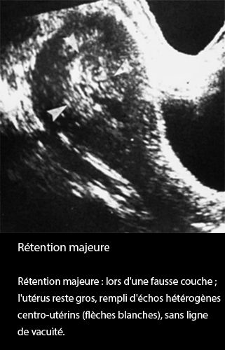 Rétention placentaire — placenta retenu post-partum échographie 1