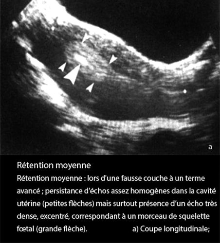 Rétention placentaire — placenta retenu post-partum échographie 2