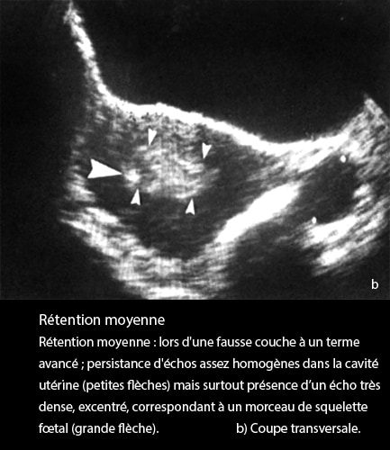 Rétention placentaire — placenta retenu post-partum échographie 3