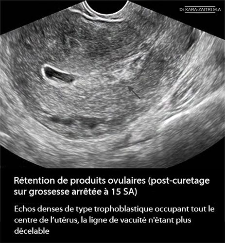 Rétention placentaire — placenta retenu post-partum échographie 4