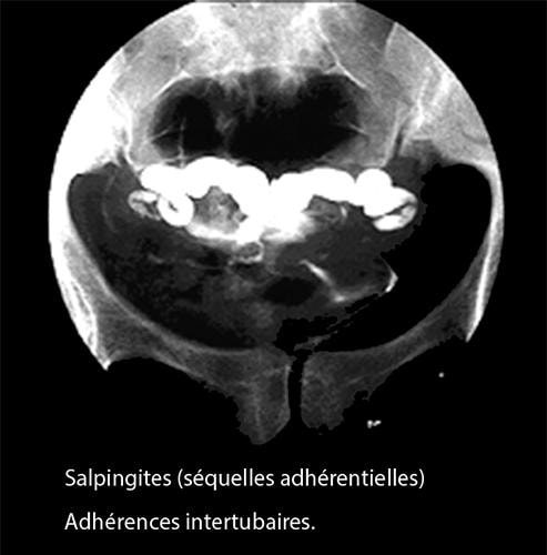 Salpingite 10