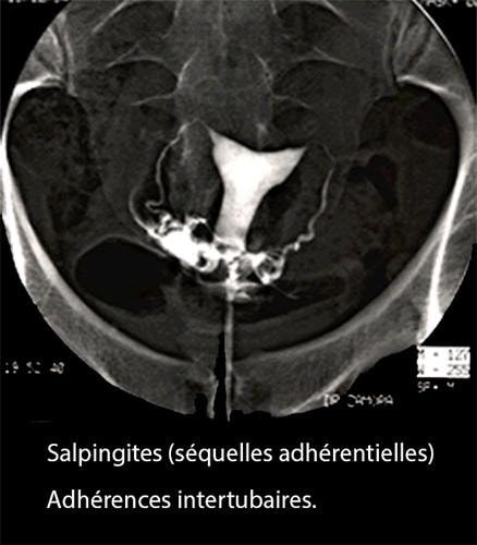 Salpingite aiguë coelioscopie — infection tubaire 11