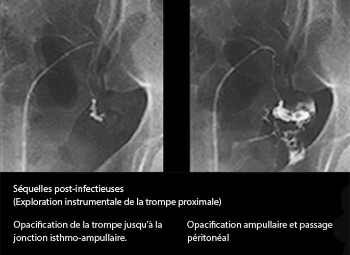 Salpingite aiguë coelioscopie — infection tubaire 12