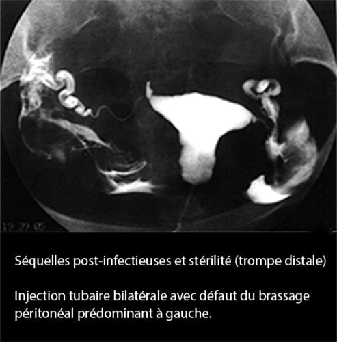 Salpingite aiguë coelioscopie — infection tubaire 15