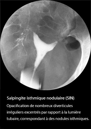 Anomalies De La Portion Proximale - Dr KARA-ZAITRI M.A