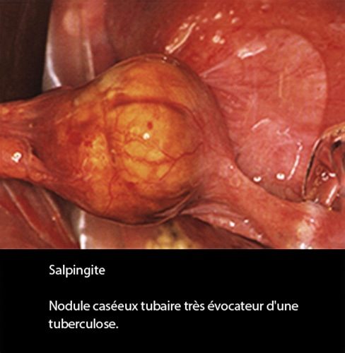 Salpingite aiguë — aspect coelioscopique infection tubaire 2