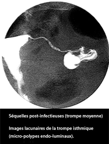 Salpingite 2