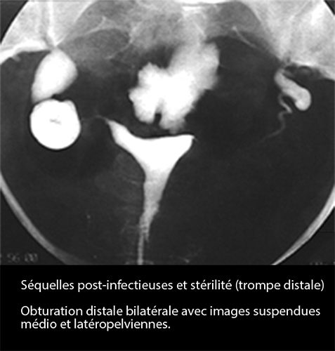 Salpingite aiguë coelioscopie — infection tubaire 21