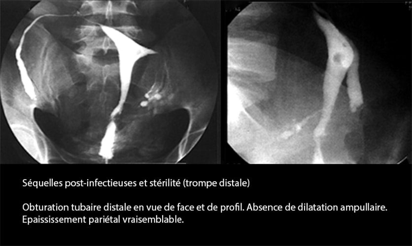 Salpingite aiguë coelioscopie — infection tubaire 23