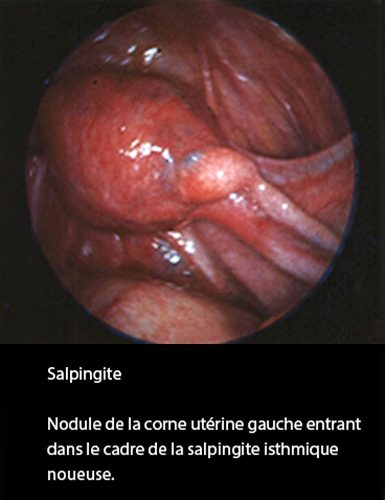 Salpingite aiguë — aspect coelioscopique infection tubaire 3