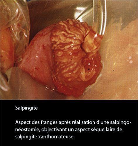 Salpingite aiguë — aspect coelioscopique infection tubaire 4
