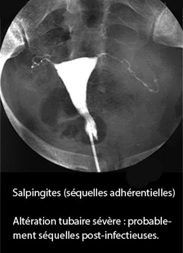 Salpingite 8