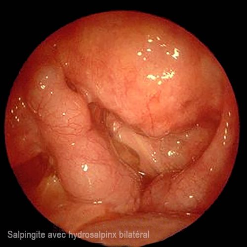 Salpingite et hydrosalpinx bilatéral coelioscopie — infection tubaire chronique