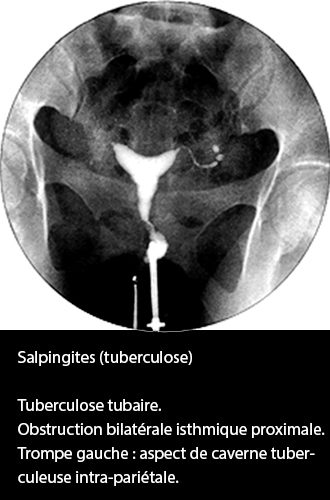 Salpingite tuberculose 2