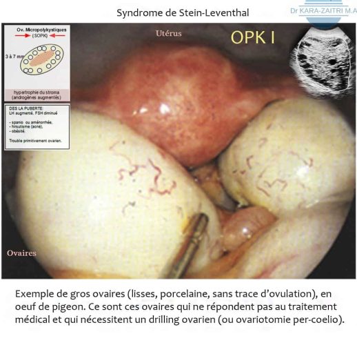 Syndrome de Stein-Leventhal — SOPK aspect macroscopique ovarien