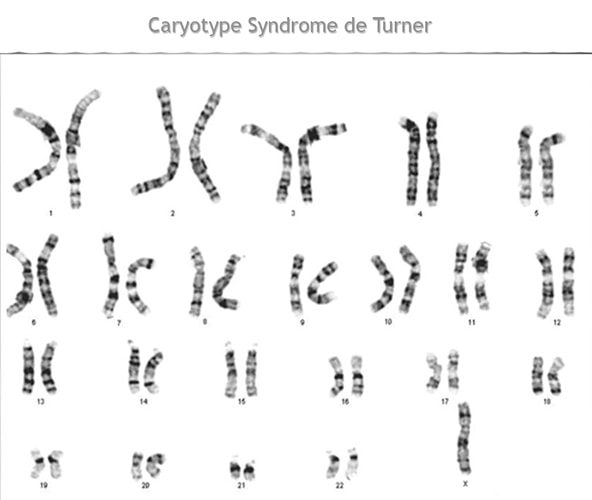 syndrome de Turner