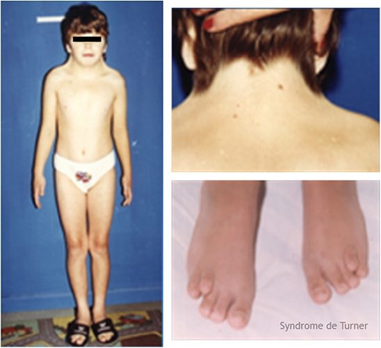 syndrome de Turner