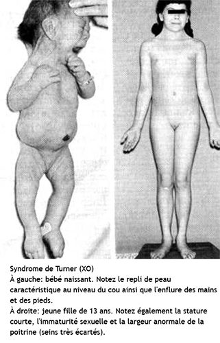 syndrome de Turner