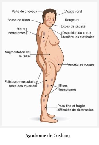 Syndrome de Cushing — manifestations cliniques hypercortisolisme 1