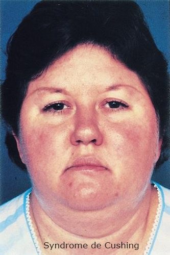 Syndrome de Cushing — manifestations cliniques hypercortisolisme 2