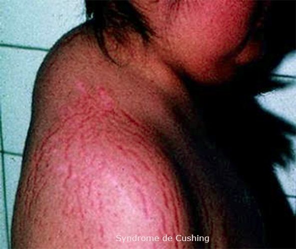 Syndrome de Cushing — manifestations cliniques hypercortisolisme 3