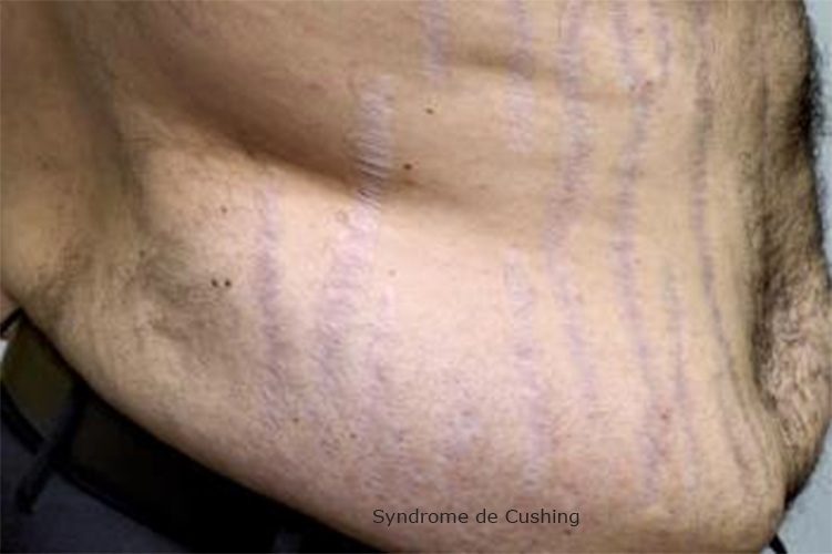 Syndrome de Cushing — manifestations cliniques hypercortisolisme 4