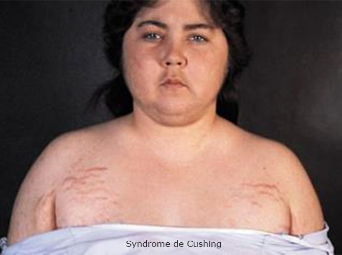 Syndrome de Cushing — manifestations cliniques hypercortisolisme 5