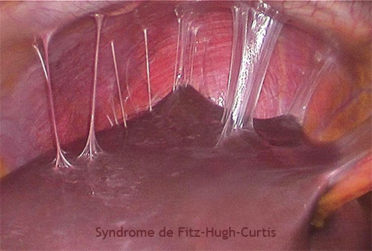 Sd de Fitz-Hugh-Curtis 2