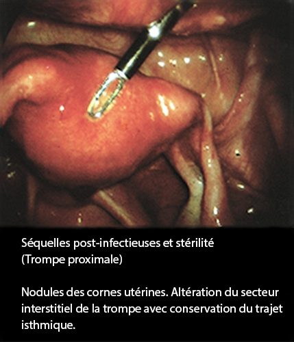 Séquelles post-infectieuses et stérilité tubaire coelioscopie 1