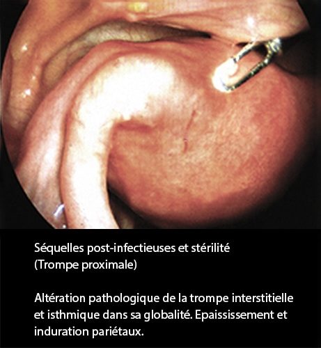 Séquelles post-infectieuses et stérilité tubaire coelioscopie 2