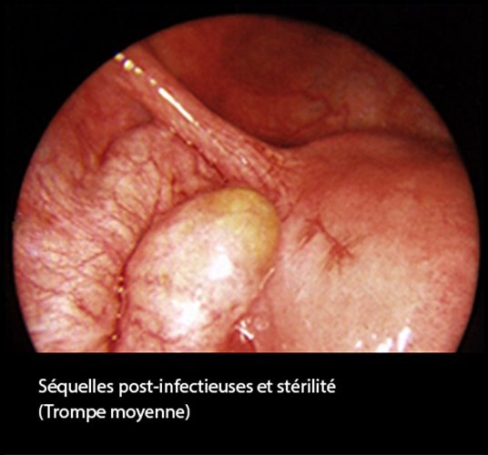 Séquelles post-infectieuses et stérilité tubaire coelioscopie 3
